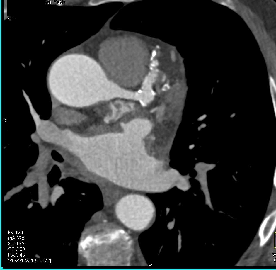 CCTA with Multiple Coronary Artery Aneurysms - CTisus CT Scan