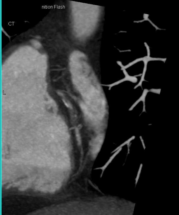 CCTA with Occluded RCA - CTisus CT Scan