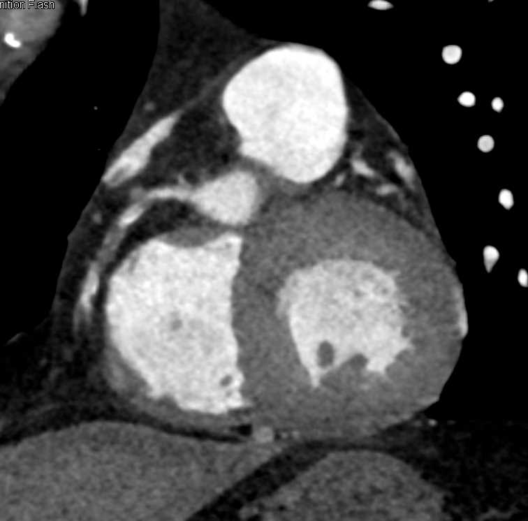 CCTA with Occluded RCA - CTisus CT Scan