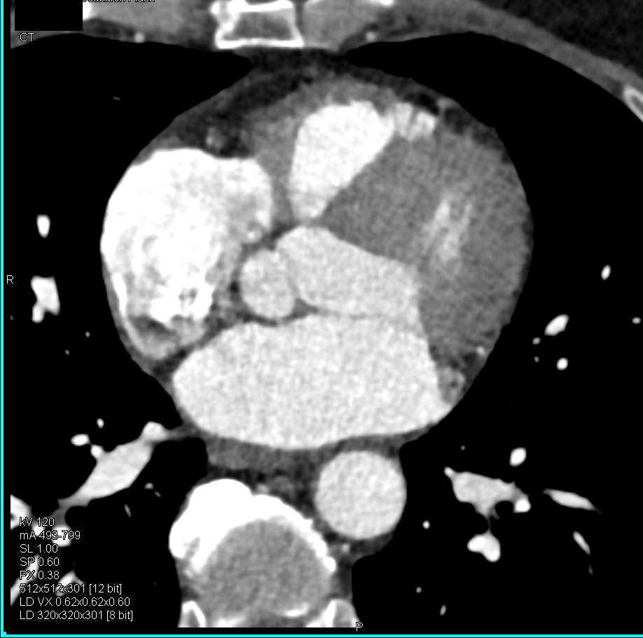 CCTA with Occluded Right Coronary Artery (RCA) - CTisus CT Scan