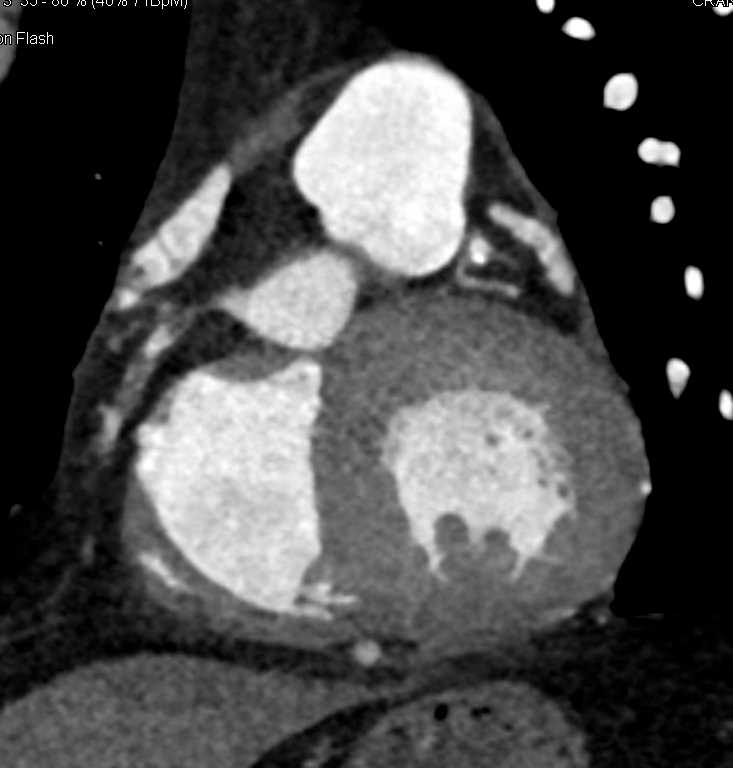 CCTA with Occluded Right Coronary Artery (RCA) - CTisus CT Scan