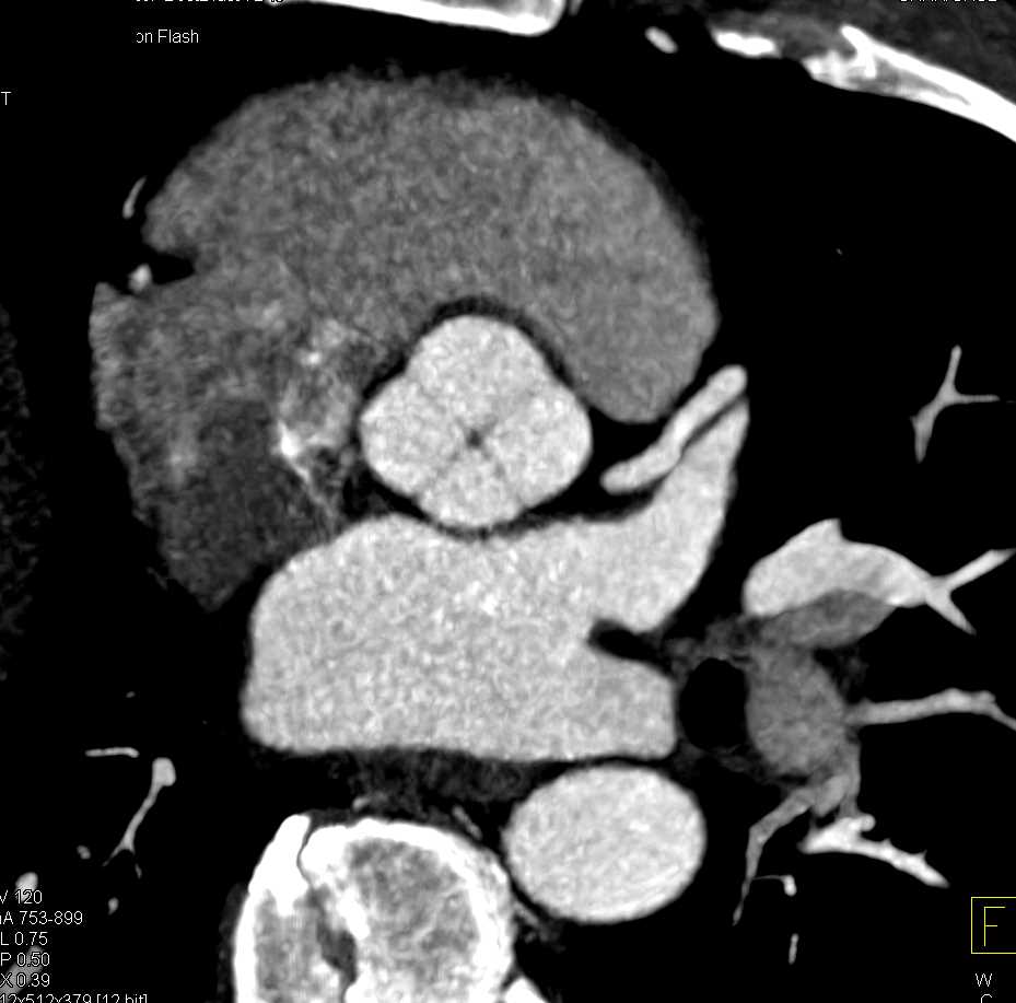 4 Cusps to Aortic Valve or Quadricuspid aortic valve  - CTisus CT Scan
