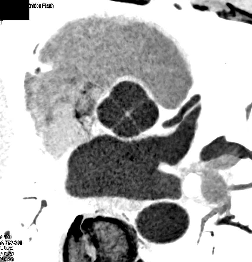 4 Cusps to Aortic Valve or Quadricuspid aortic valve  - CTisus CT Scan