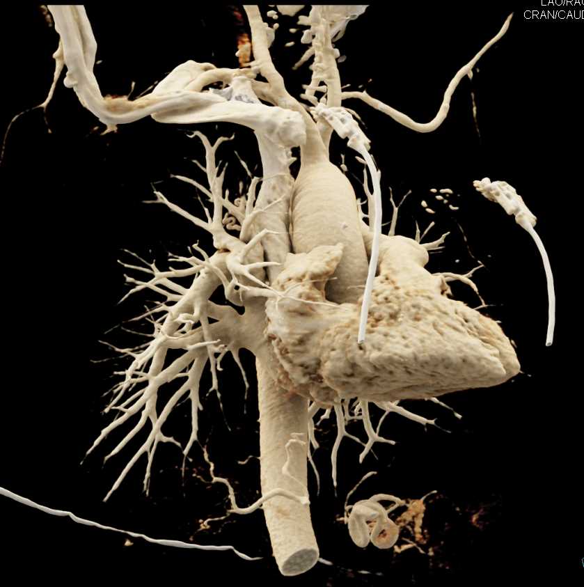 Branch Vessels off the Arch - CTisus CT Scan