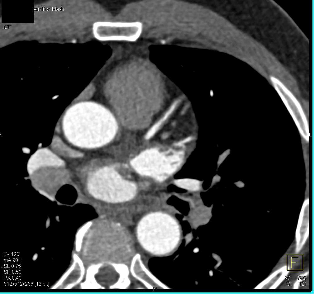 CCTA with 50% Left Anterior Descending Artery (LAD) Stenosis - CTisus CT Scan