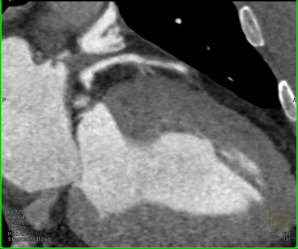 CCTA with 50% Left Anterior Descending Artery (LAD) Stenosis - CTisus CT Scan