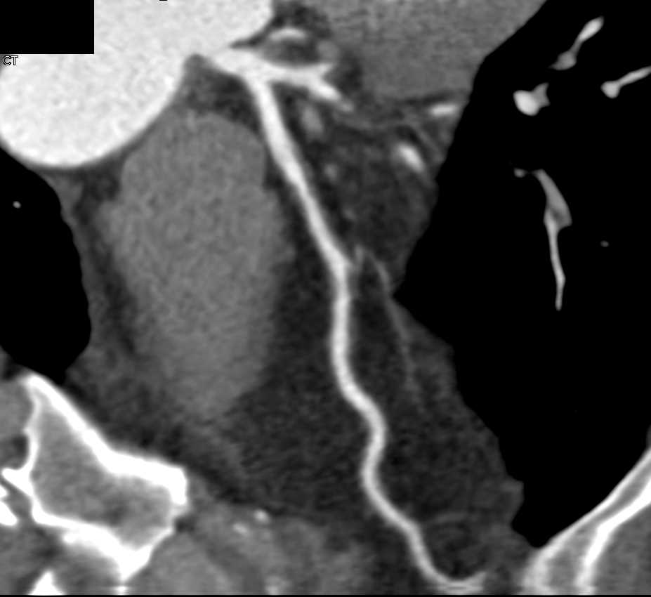 CCTA with 50% LAD Stenosis - CTisus CT Scan