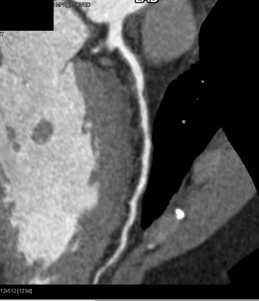 CCTA with 50% LAD Stenosis - CTisus CT Scan
