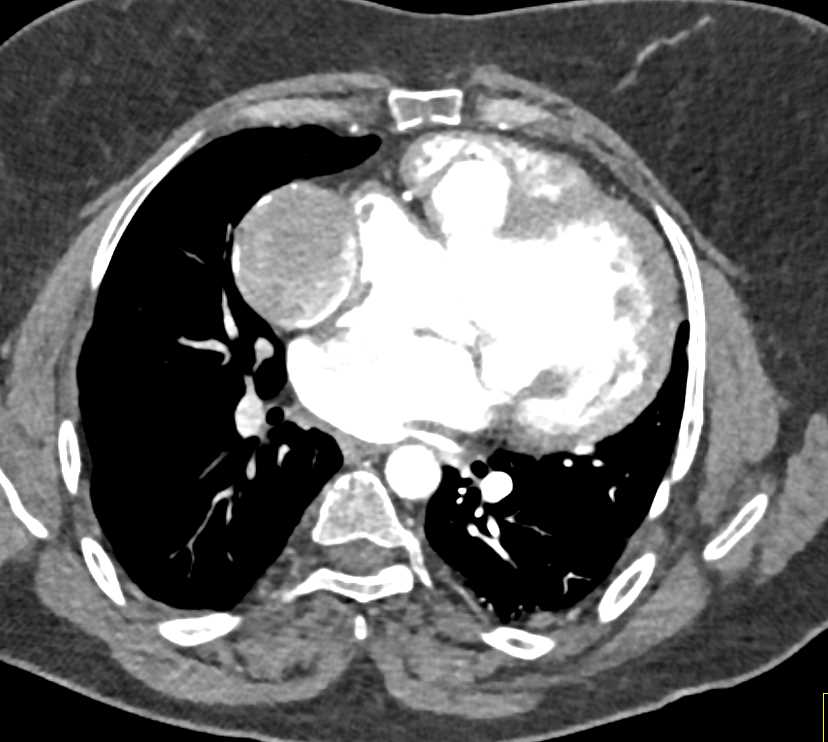 Pulmonary Embolism in Patient with Complex Cardiac Anomalies - CTisus CT Scan