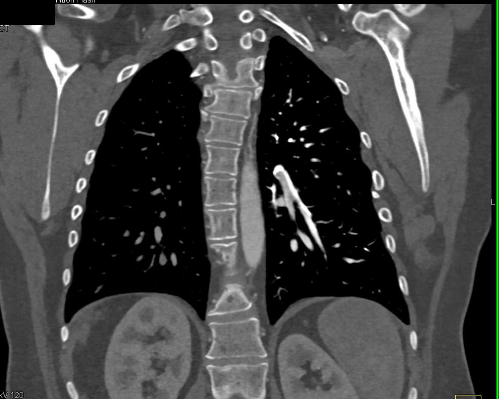 Pulmonary Embolism in Patient with Complex Cardiac Anomalies - CTisus CT Scan