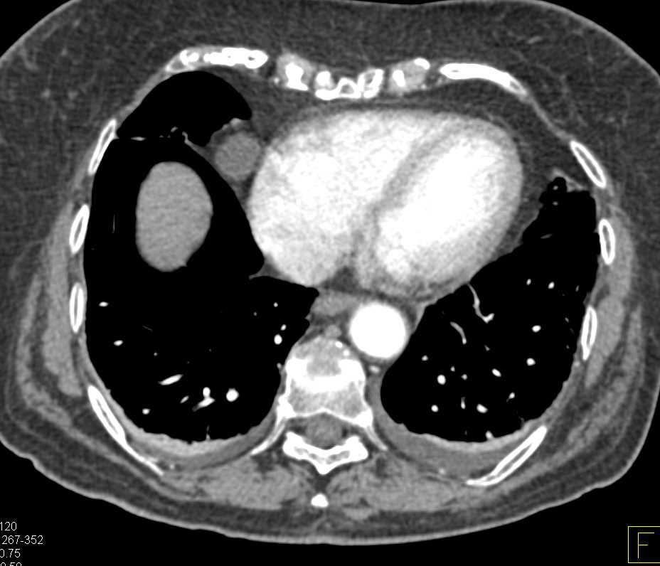 2cm Pericardial Cyst - CTisus CT Scan