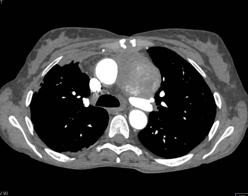 Pseudoaneurysm Aorta with Delayed Filling - CTisus CT Scan