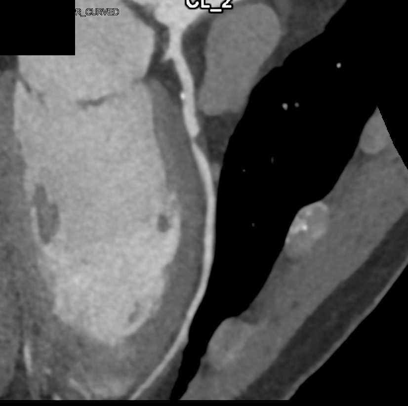 CCTA with High Grade Stenosis in the Left Anterior Descending Artery (LAD) - CTisus CT Scan