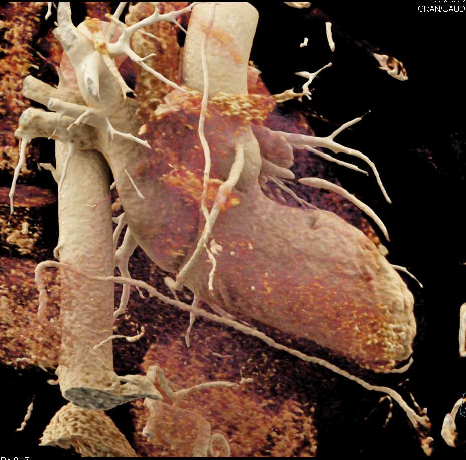 CCTA with High Grade Left Anterior Descending Artery (LAD) Stenosis with Cinematic Rendering - CTisus CT Scan