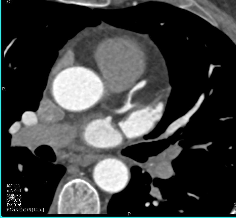 CCTA with Left Anterior Descending Artery (LAD) Stenosis due to Non Calcified Plaque - CTisus CT Scan