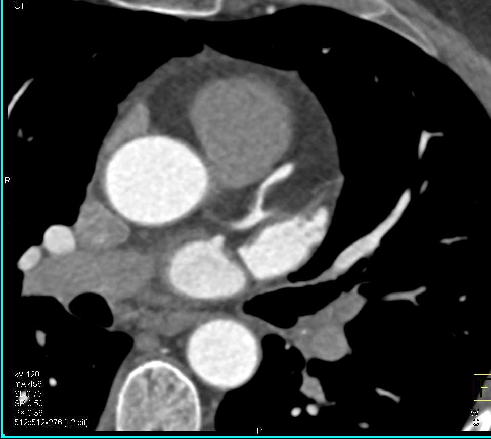 CCTA with LAD Stenosis due to Non Calcified Plaque - CTisus CT Scan