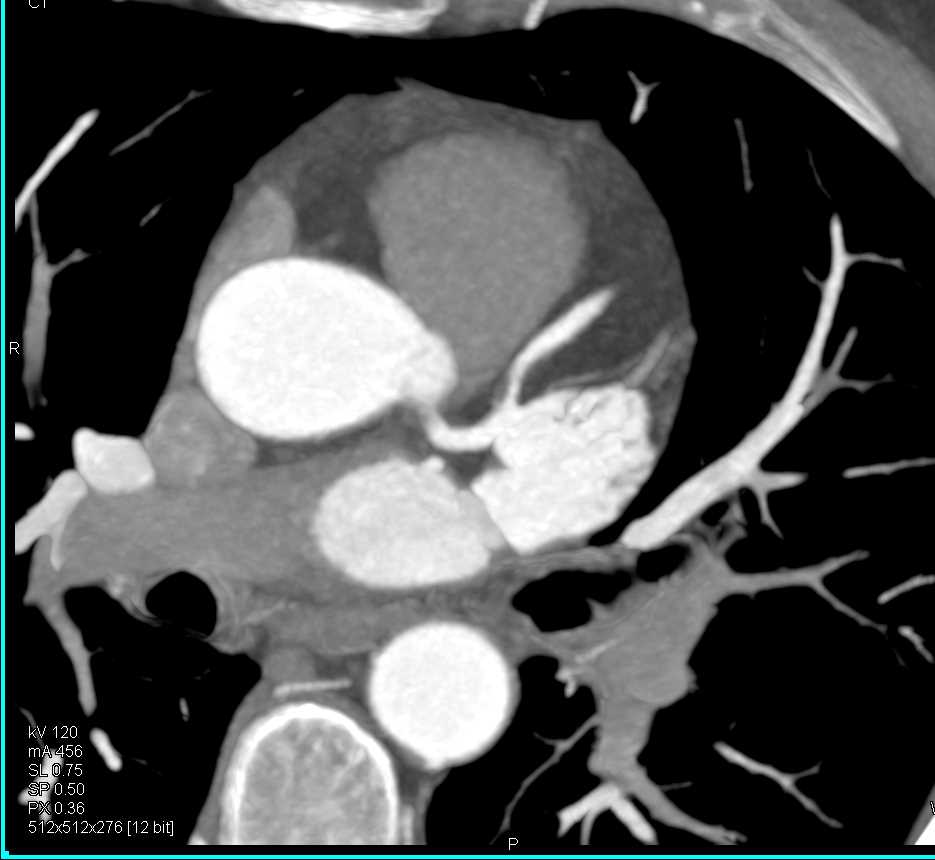 CCTA with Left Anterior Descending Artery (LAD) Stenosis due to Non Calcified Plaque - CTisus CT Scan