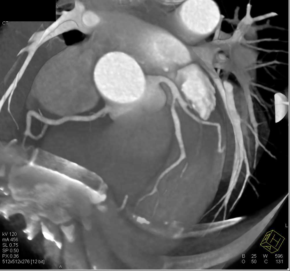 CCTA with LAD Stenosis due to Non Calcified Plaque - CTisus CT Scan
