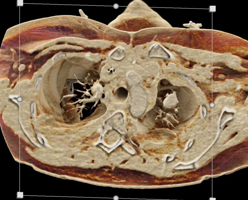 Dilated Left Ventricle - CTisus CT Scan