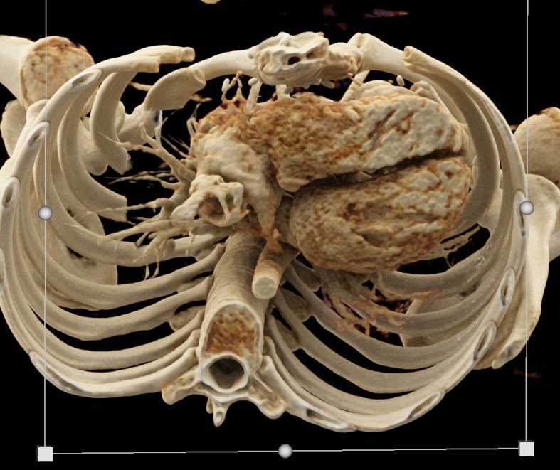 Dilated Left Ventricle - CTisus CT Scan