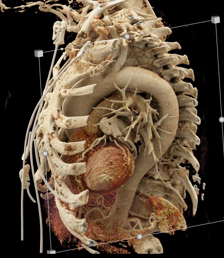 Left Atrial Appendage and Anatomy from a Sagittal View with Cinematic Rendering (CR) - CTisus CT Scan
