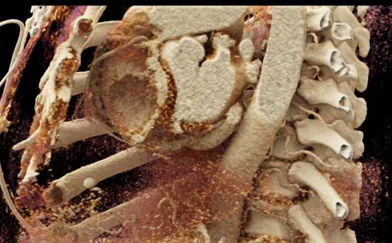 Cardiac Lymphoma - CTisus CT Scan