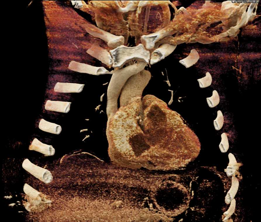 Cardiac Lymphoma - CTisus CT Scan