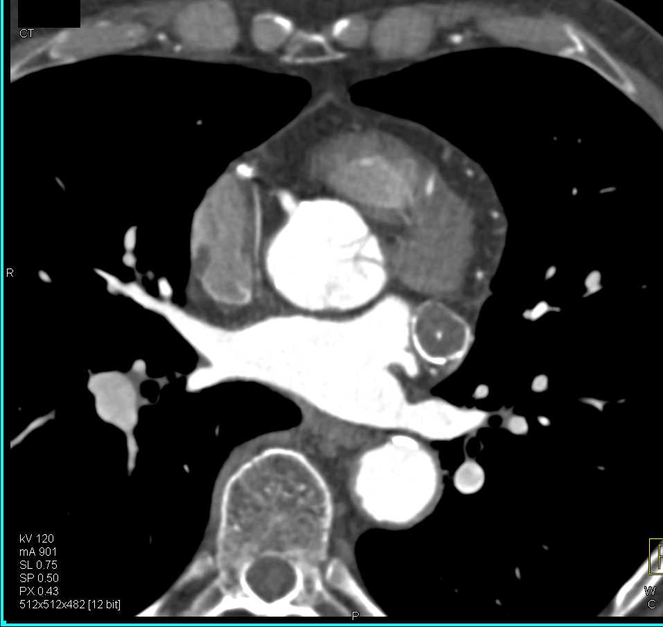 CCTA: Aneurysm of the Circumflex Coronary Artery - CTisus CT Scan