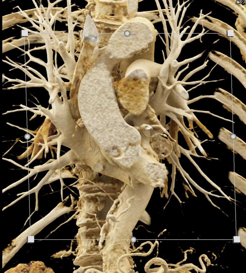 CCTA: Aneurysm of the Circumflex Coronary Artery with Cinematic Rendering - CTisus CT Scan