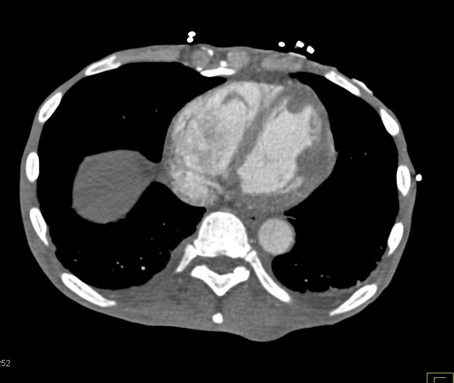 Metastases to the Left Ventricle - CTisus CT Scan