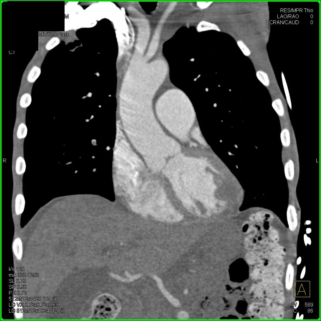 Metastases to the Left Ventricle - CTisus CT Scan