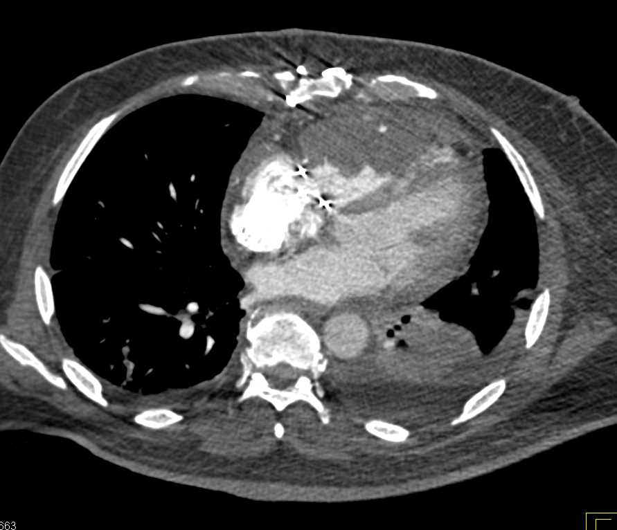 Metastatic Melanoma to Right Ventricle - CTisus CT Scan