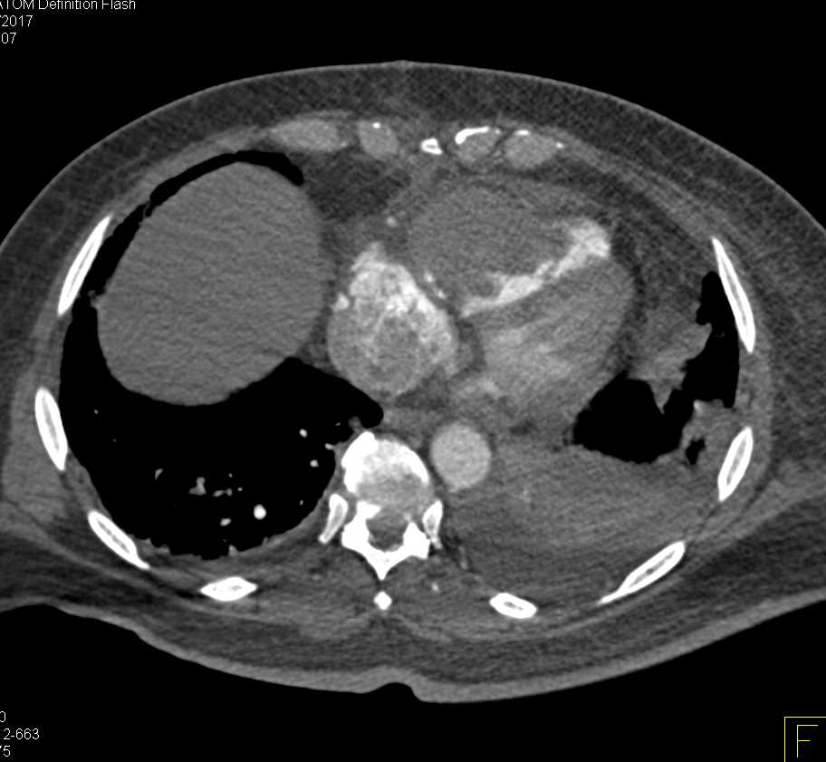 Metastatic Melanoma to Right Ventricle - CTisus CT Scan