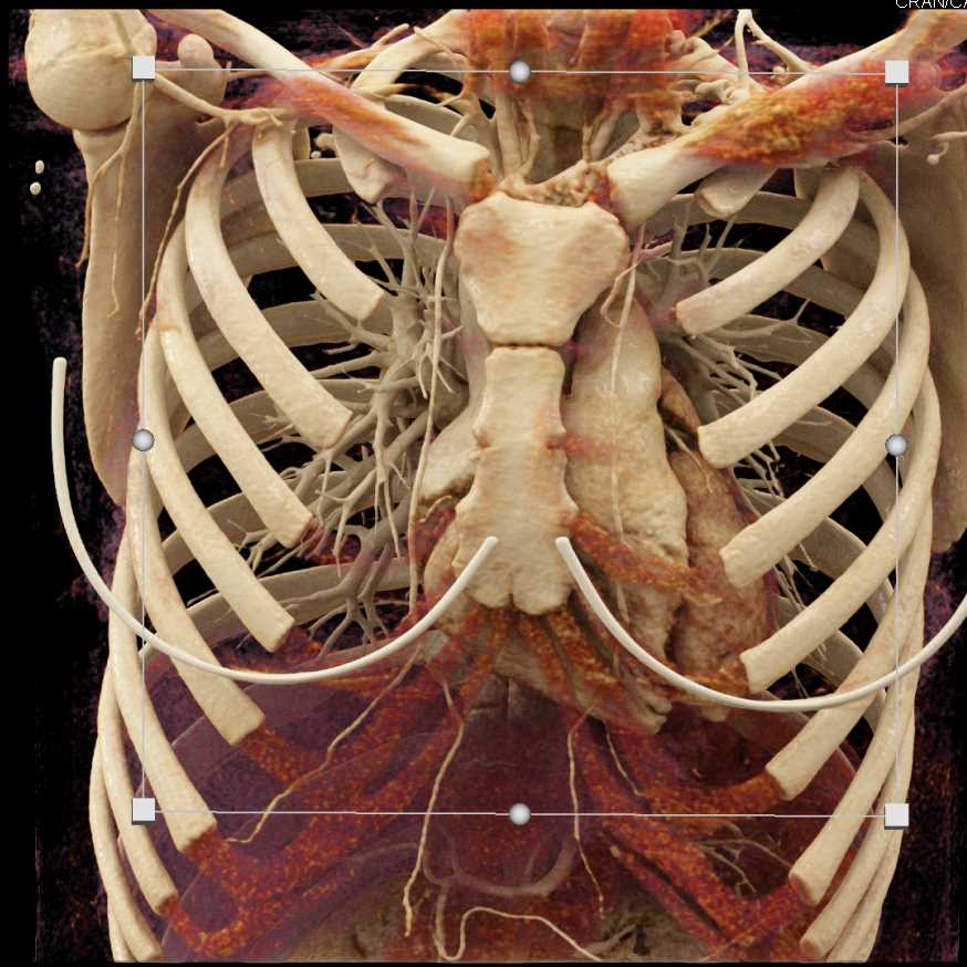 Cinematic Rendering of the Heart - CTisus CT Scan