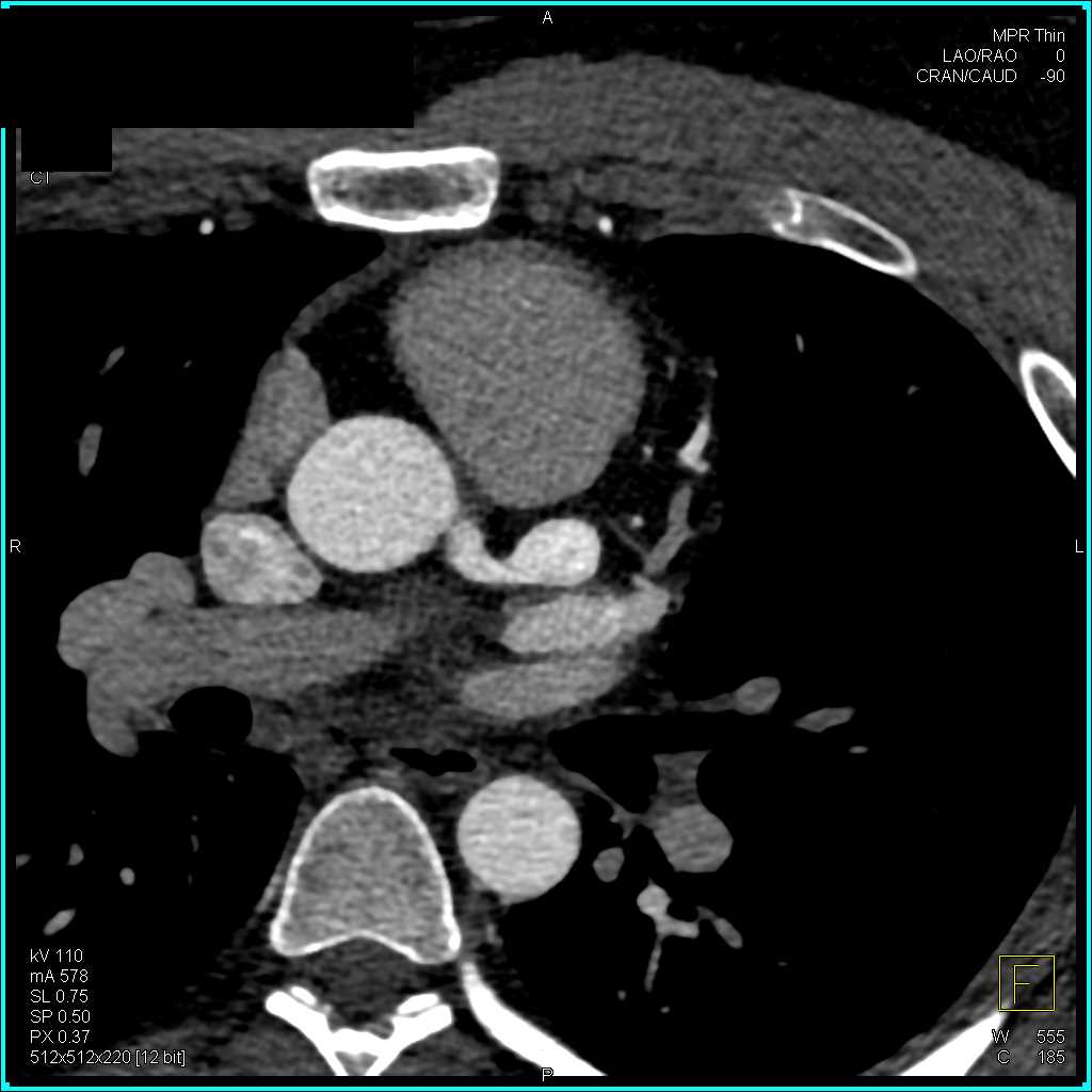 Left Anterior Descending Artery (LAD) Aneurysm - CTisus CT Scan