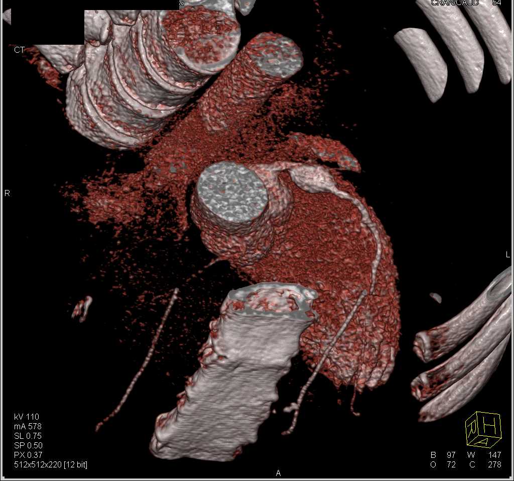 LAD Aneurysm - CTisus CT Scan