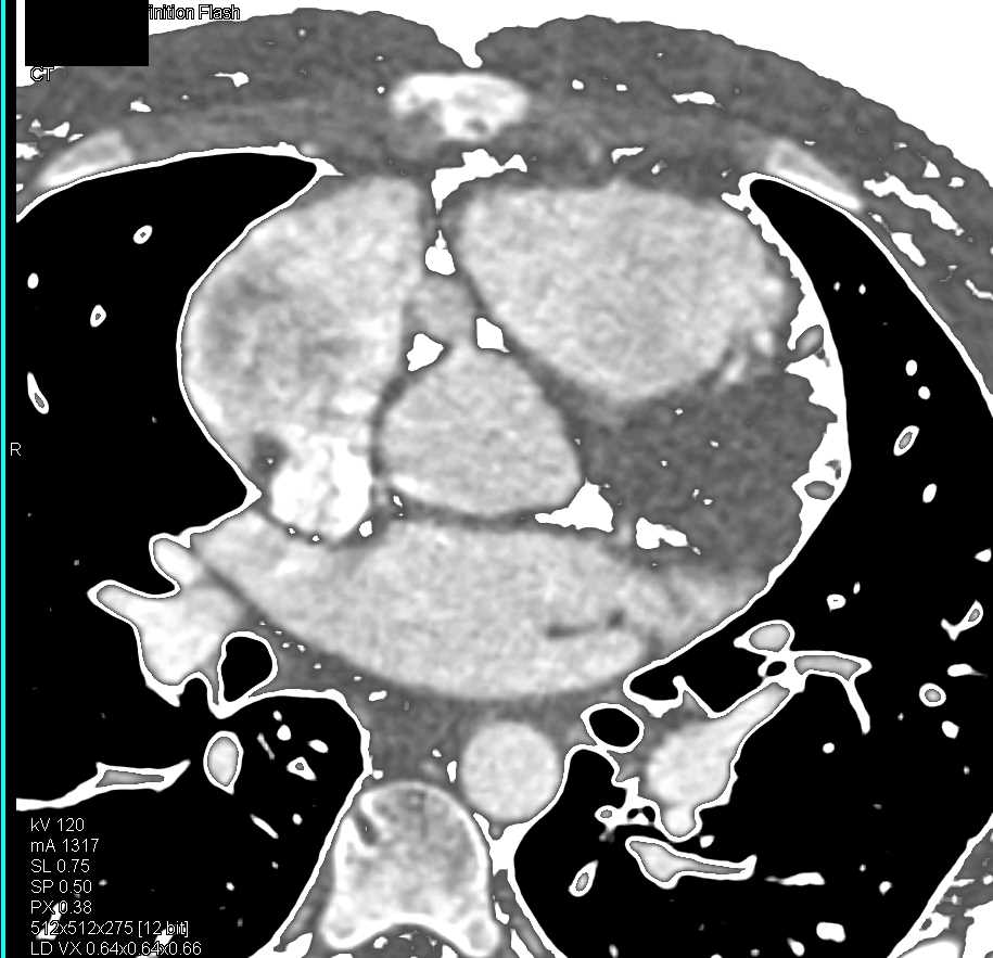 Right Coronary Artery Aneurysm - CTisus CT Scan