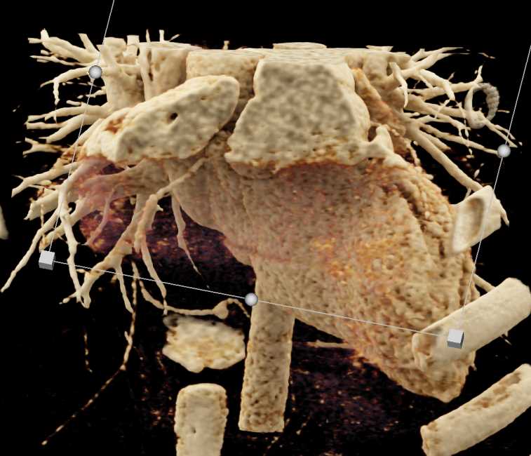 Right Coronary Artery Aneurysm - CTisus CT Scan