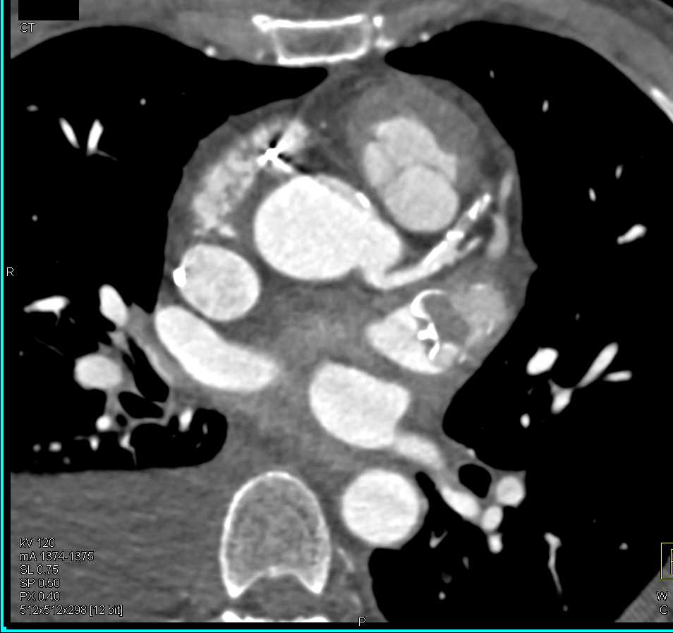 Watchman Atrial Appendage Occluder - CTisus CT Scan