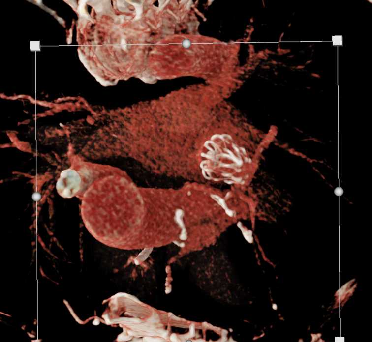 Watchman Atrial Appendage Occluder - CTisus CT Scan