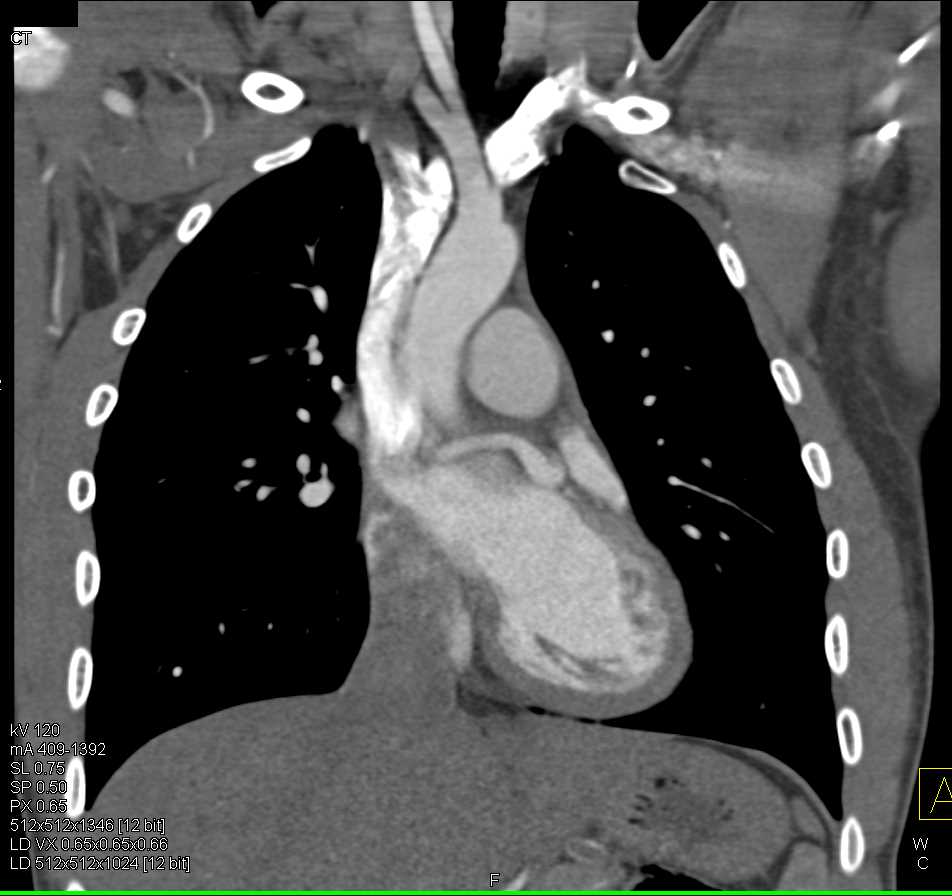 Aberrant Course of Circumflex Coronary Artery from Right Cusp - CTisus CT Scan
