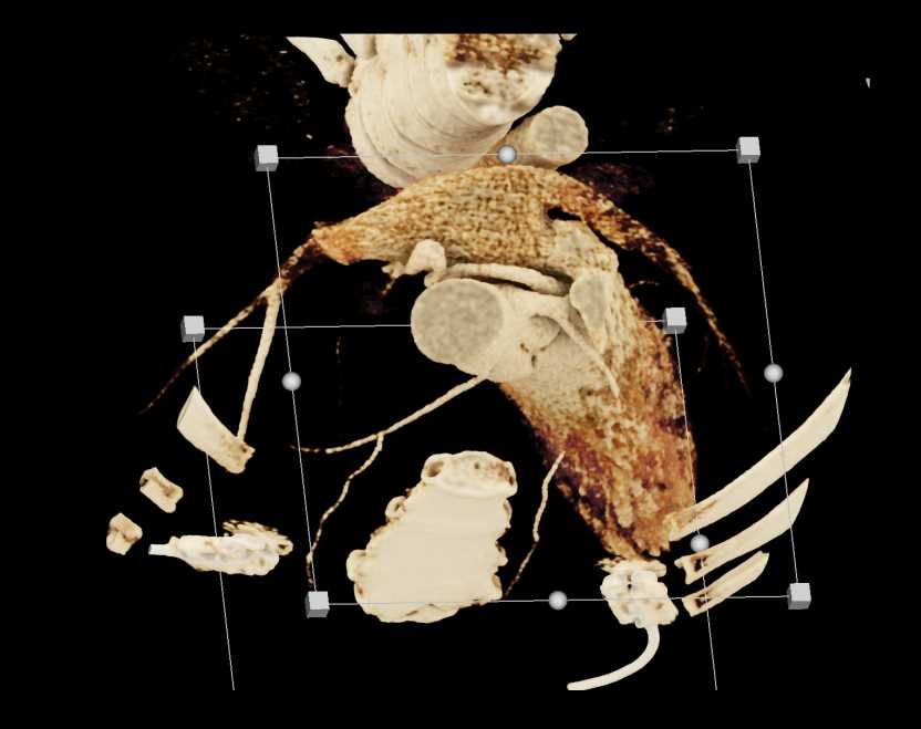 Aberrant Course of Circumflex Coronary Artery from Right Cusp - CTisus CT Scan