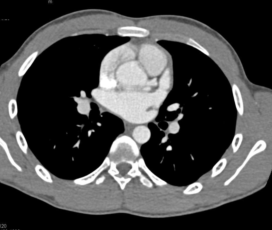 Coronary Artery Anomaly of the Right Coronary Artery (RCA) - CTisus CT Scan