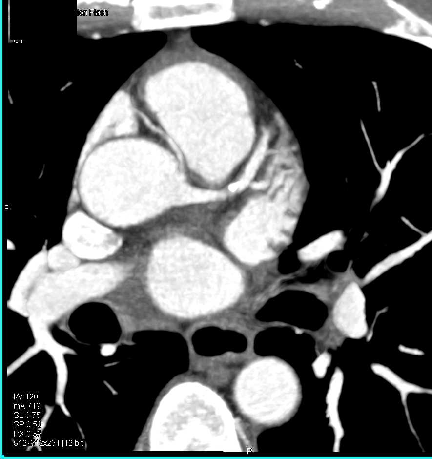 CCTA: Right Coronary Artery (RCA) Arises off the Left Cusp - CTisus CT Scan