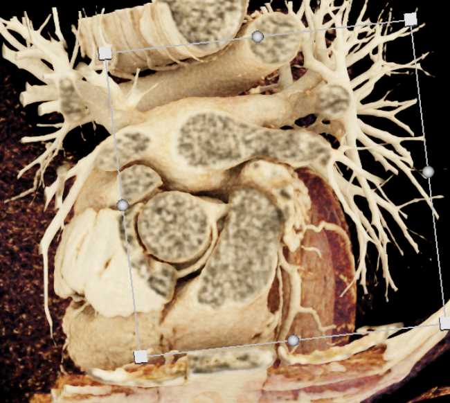 CCTA: Right Coronary Artery (RCA) Arises off the Left Cusp with Cinematic Rendering - CTisus CT Scan