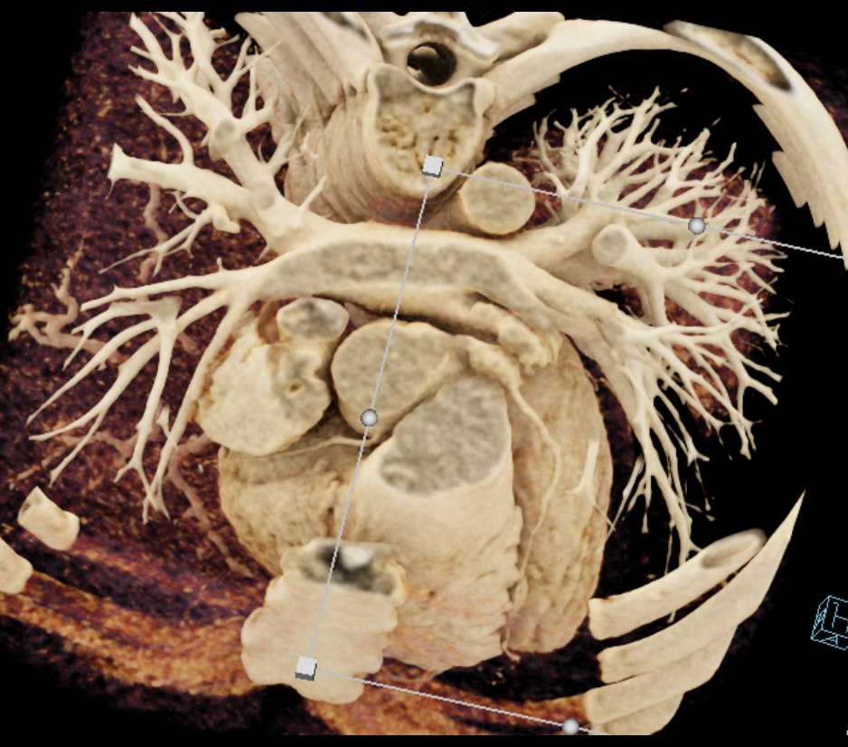 Coronary Artery Aneurysm at Bifurcation of Left Anterior Descending Artery (LAD) and Circumflex Artery (CX) - CTisus CT Scan