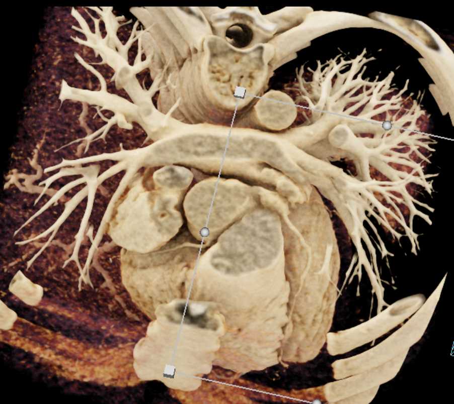 Left Anterior Descending Artery (LAD) Aneurysm - CTisus CT Scan
