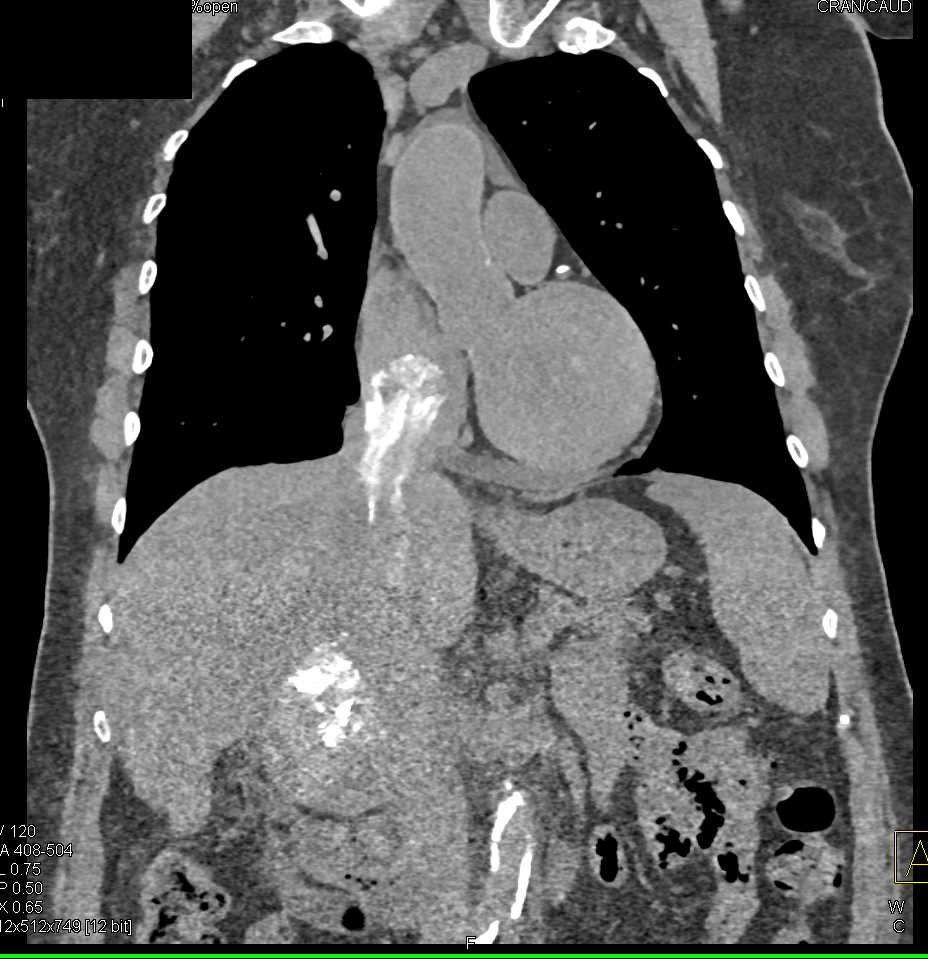 Tumor Extends into Heart from IVC - CTisus CT Scan