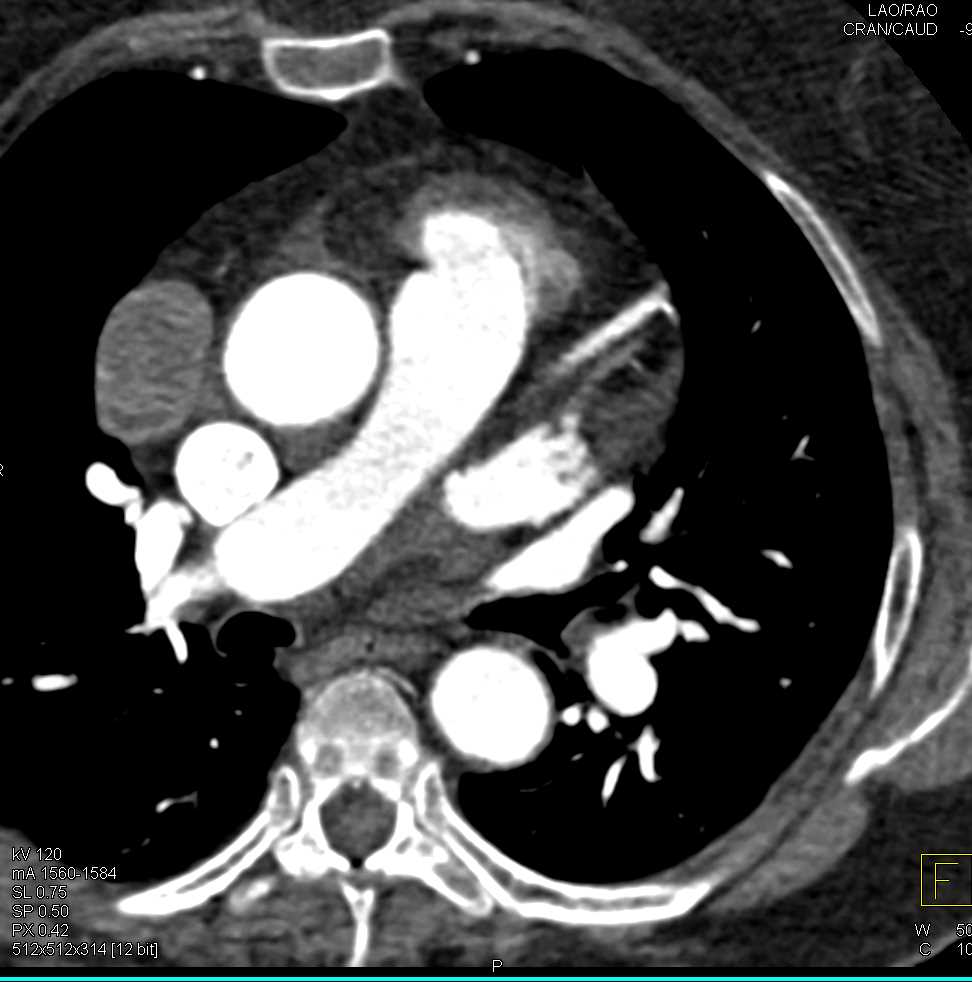 Pericardial Cyst - CTisus CT Scan