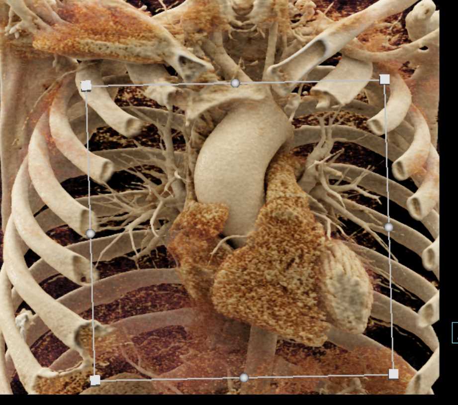 Extensive Aortic Valve Calcification - CTisus CT Scan